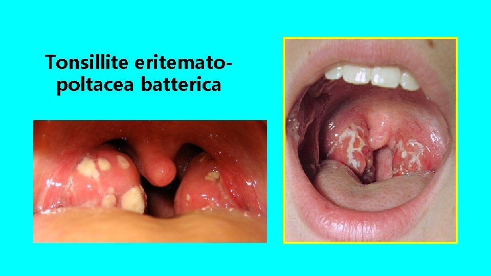 Tonsillite eritematopoltacea batterica 