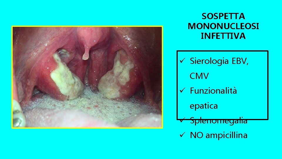 SOSPETTA MONONUCLEOSI INFETTIVA ü Sierologia EBV, CMV ü Funzionalità epatica ü Splenomegalia ü NO