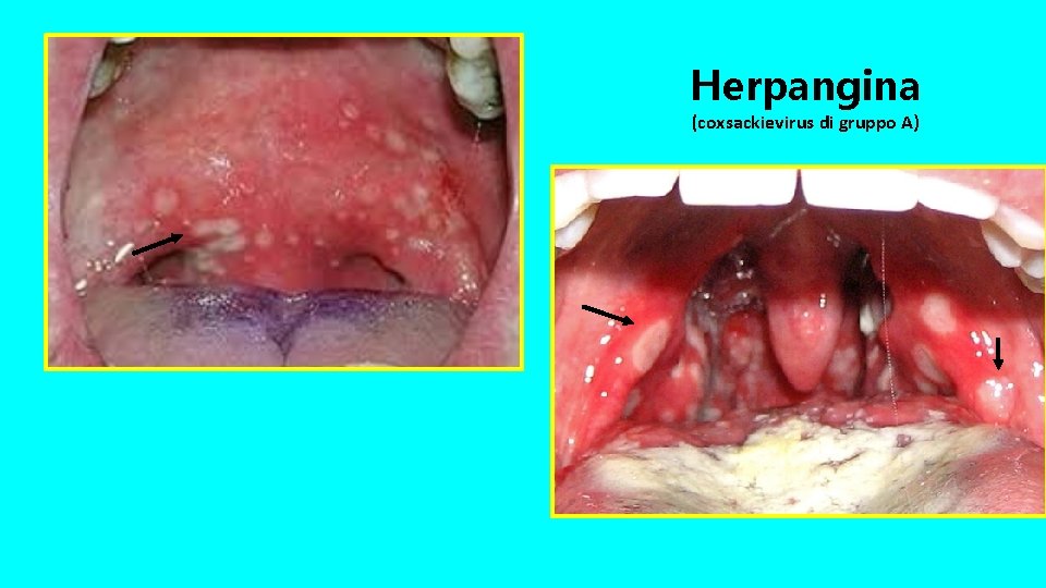 Herpangina (coxsackievirus di gruppo A) 