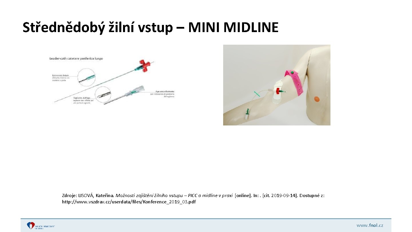 Střednědobý žilní vstup – MINI MIDLINE Zdroje: LISOVÁ, Kateřina. Možnosti zajištění žilního vstupu –