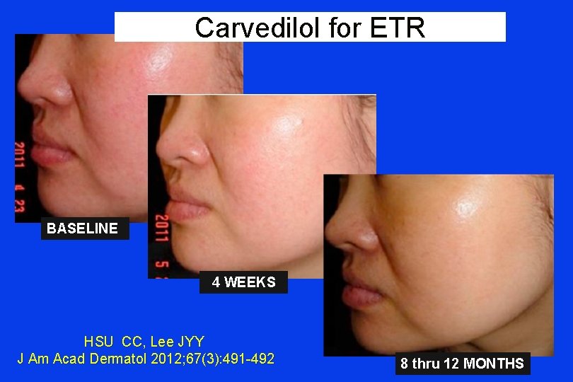 Carvedilol for ETR BASELINE 4 WEEKS HSU CC, Lee JYY J Am Acad Dermatol