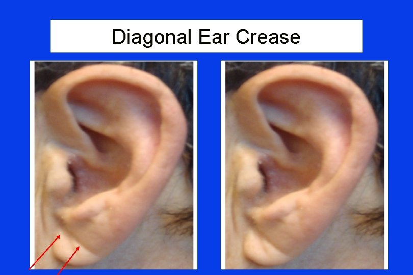 Diagonal Ear Crease 
