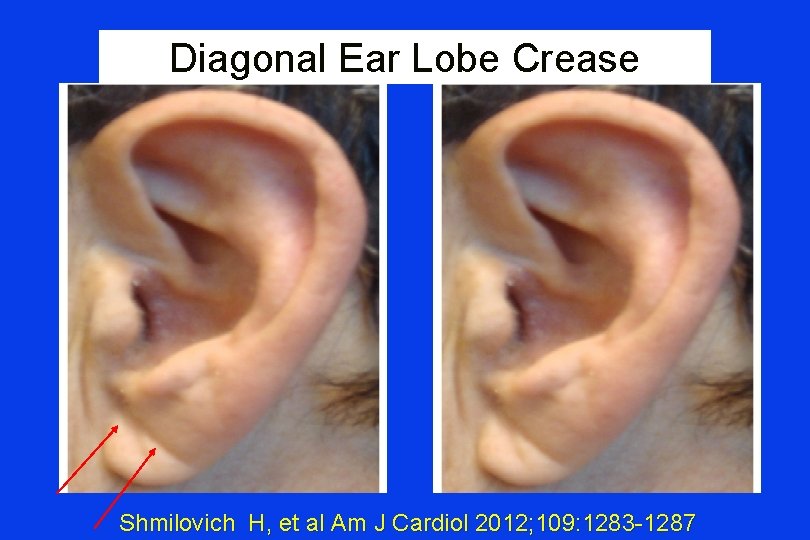 Diagonal Ear Lobe Crease Shmilovich H, et al Am J Cardiol 2012; 109: 1283