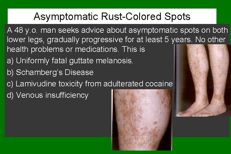 Asymptomatic Rust-Colored Spots A 48 y. o. man seeks advice about asymptomatic spots on