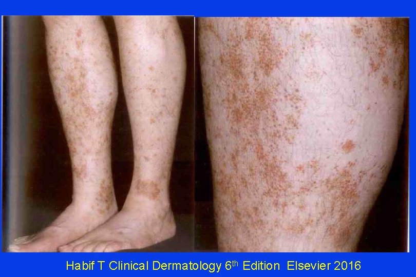 Habif T Clinical Dermatology 6 th Edition Elsevier 2016 