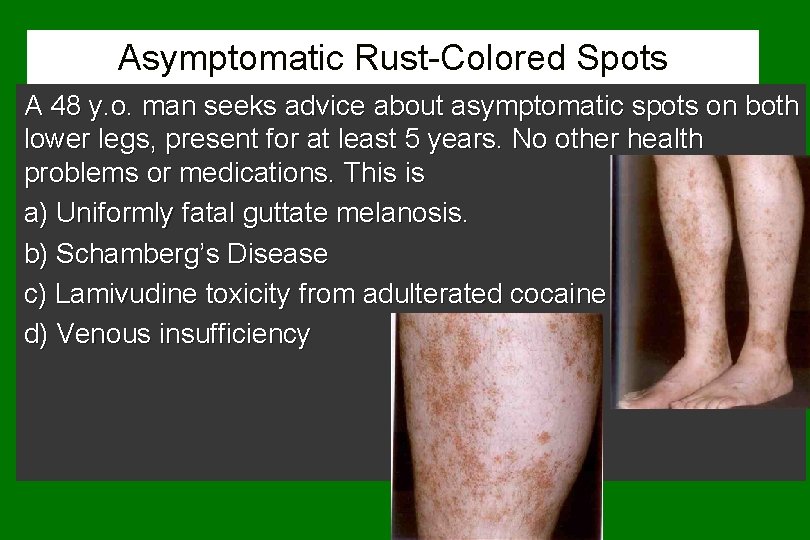 Asymptomatic Rust-Colored Spots A 48 y. o. man seeks advice about asymptomatic spots on