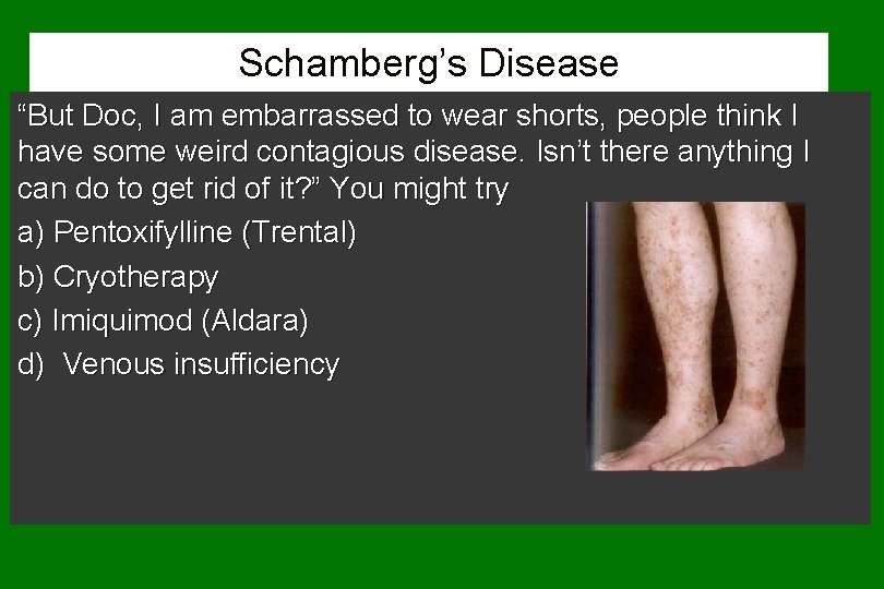 Schamberg’s Disease “But Doc, I am embarrassed to wear shorts, people think I have