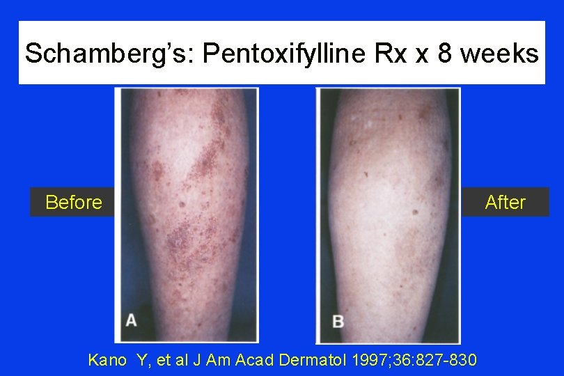 Schamberg’s: Pentoxifylline Rx x 8 weeks Before Kano Y, et al J Am Acad