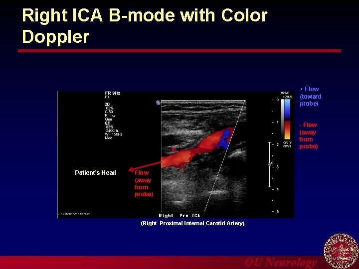 Right ICA B-mode with Color Doppler + Flow (toward probe) - Flow (away from