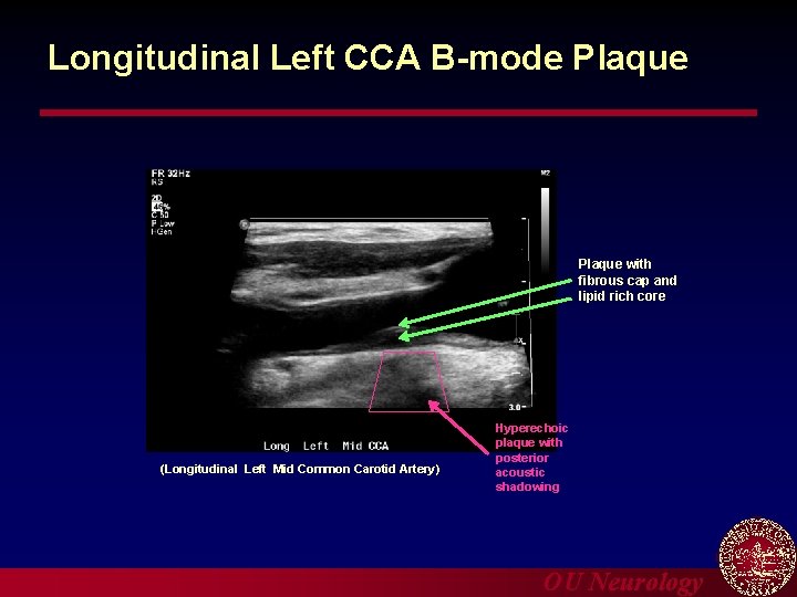 Longitudinal Left CCA B-mode Plaque with fibrous cap and lipid rich core (Longitudinal Left
