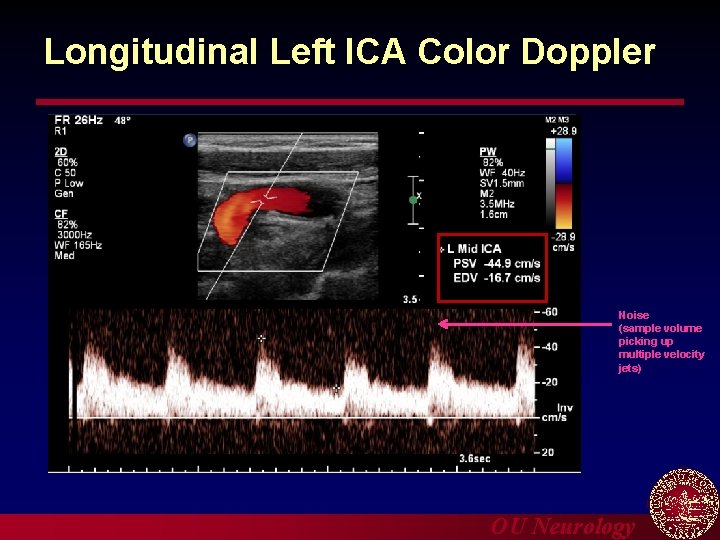 Longitudinal Left ICA Color Doppler Noise (sample volume picking up multiple velocity jets) OU