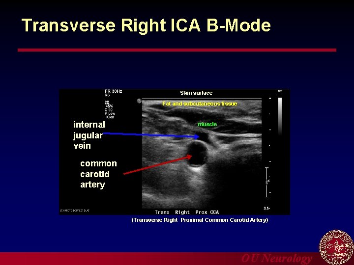 Transverse Right ICA B-Mode Skin surface Fat and subcutaneous tissue internal jugular vein muscle