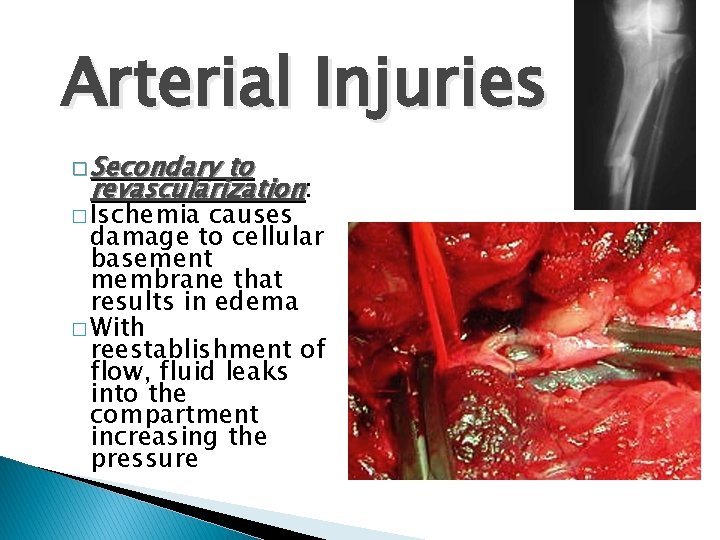 Arterial Injuries � Secondary to revascularization: � Ischemia causes damage to cellular basement membrane