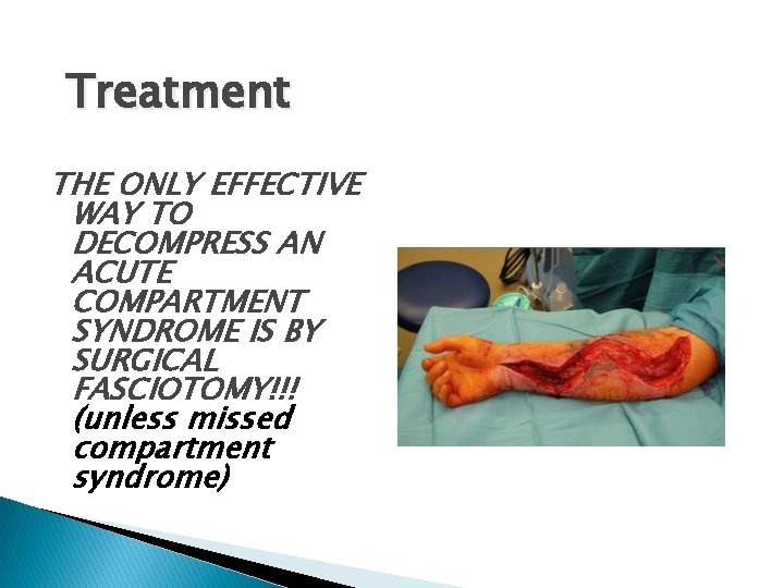 Treatment THE ONLY EFFECTIVE WAY TO DECOMPRESS AN ACUTE COMPARTMENT SYNDROME IS BY SURGICAL