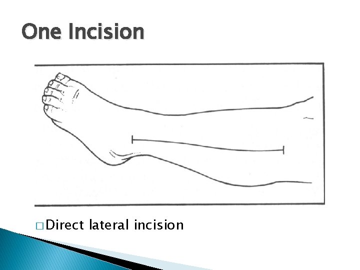 One Incision � Direct lateral incision 