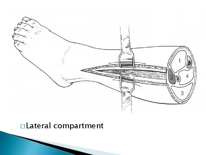 � Lateral compartment 