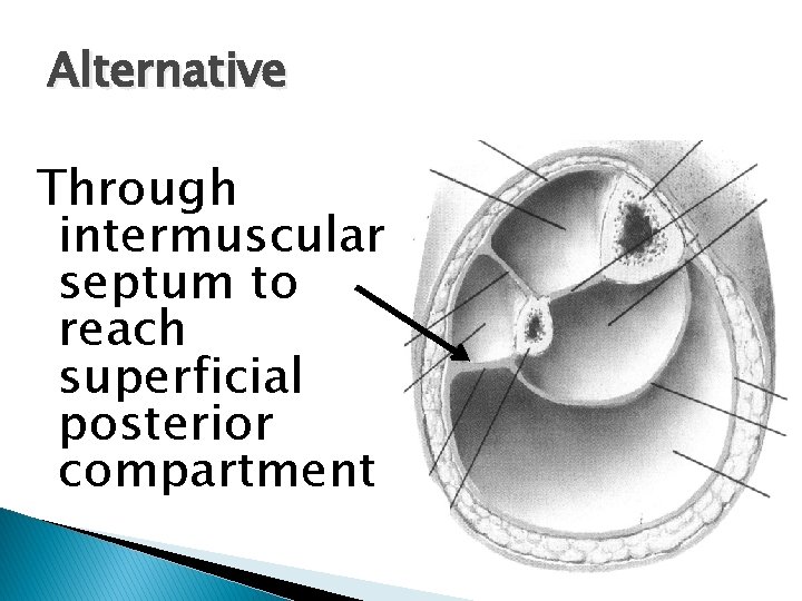 Alternative Through intermuscular septum to reach superficial posterior compartment 