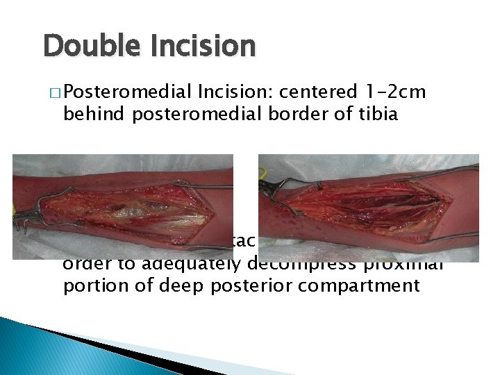 Double Incision � Posteromedial Incision: centered 1 -2 cm behind posteromedial border of tibia