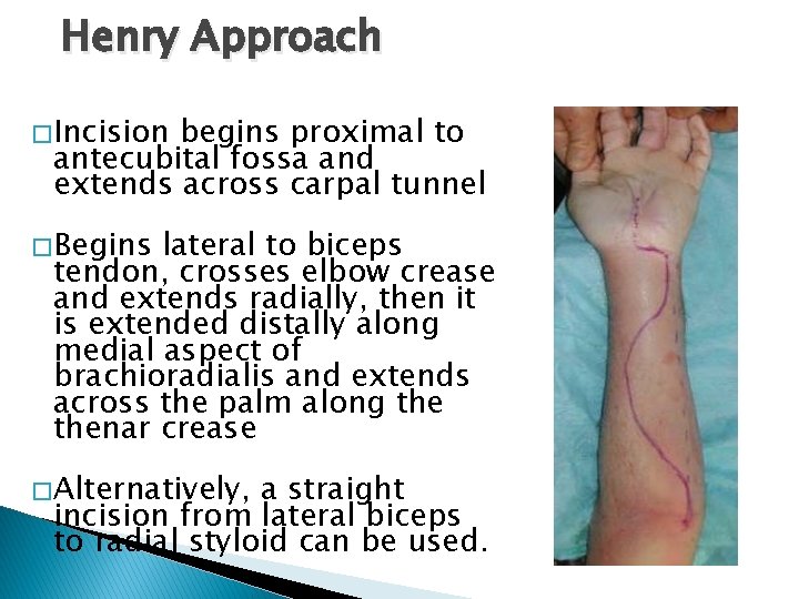 Henry Approach � Incision begins proximal to antecubital fossa and extends across carpal tunnel