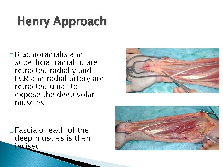 Henry Approach � Brachioradialis and superficial radial n. are retracted radially and FCR and