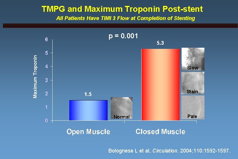 TMPG and Maximum Troponin Post-stent All Patients Have TIMI 3 Flow at Completion of