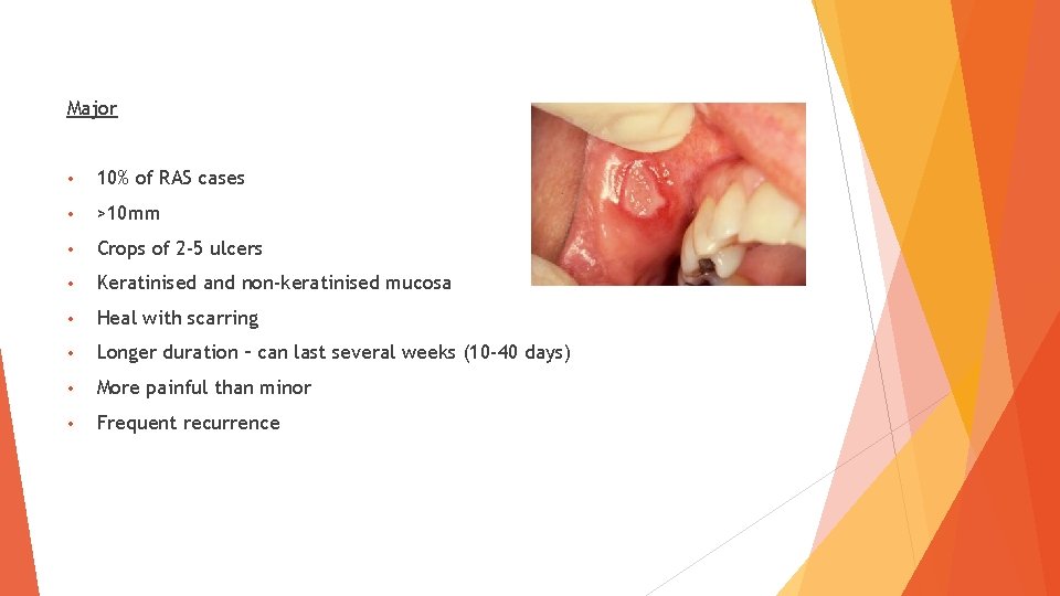 Major • 10% of RAS cases • >10 mm • Crops of 2 -5