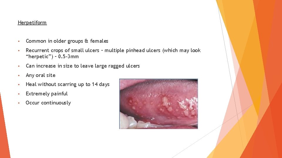 Herpetiform • Common in older groups & females • Recurrent crops of small ulcers