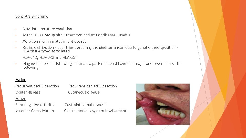 Behcet’s Syndrome • Auto-inflammatory condition • Apthous like oro-genital ulceration and ocular disease –