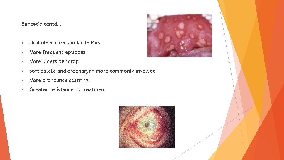 Behcet’s contd… • Oral ulceration similar to RAS • More frequent episodes • More