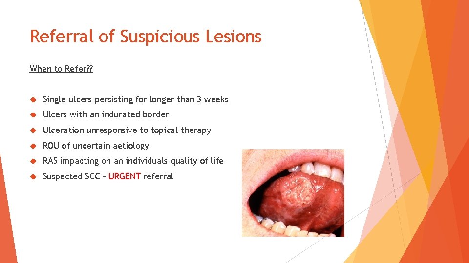 Referral of Suspicious Lesions When to Refer? ? Single ulcers persisting for longer than