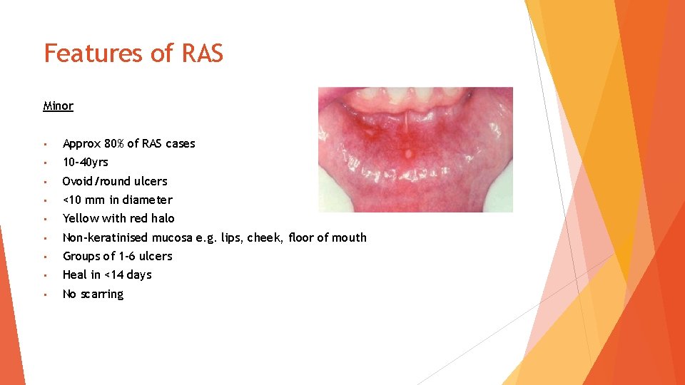 Features of RAS Minor • Approx 80% of RAS cases • 10 -40 yrs