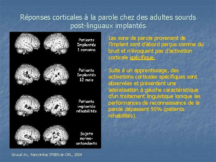 Réponses corticales à la parole chez des adultes sourds post-linguaux implantés Les sons de