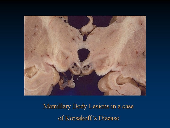 Mamillary Body Lesions in a case of Korsakoff’s Disease 