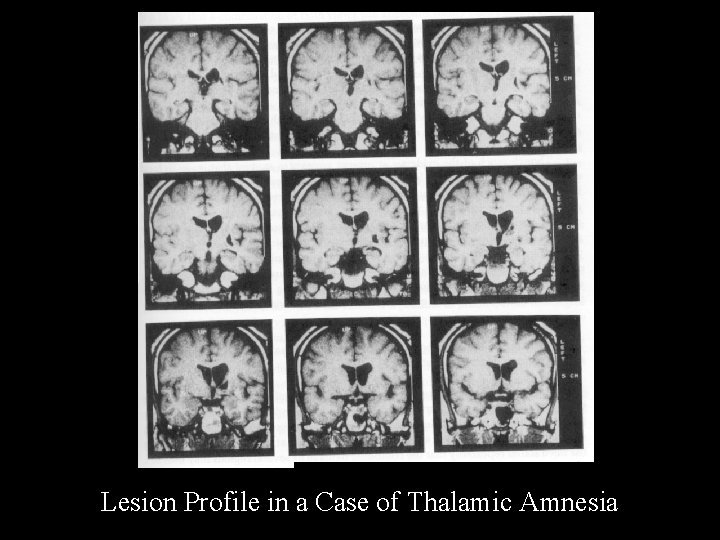 Lesion Profile in a Case of Thalamic Amnesia 