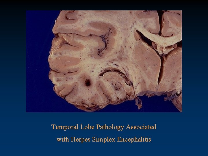 Temporal Lobe Pathology Associated with Herpes Simplex Encephalitis 