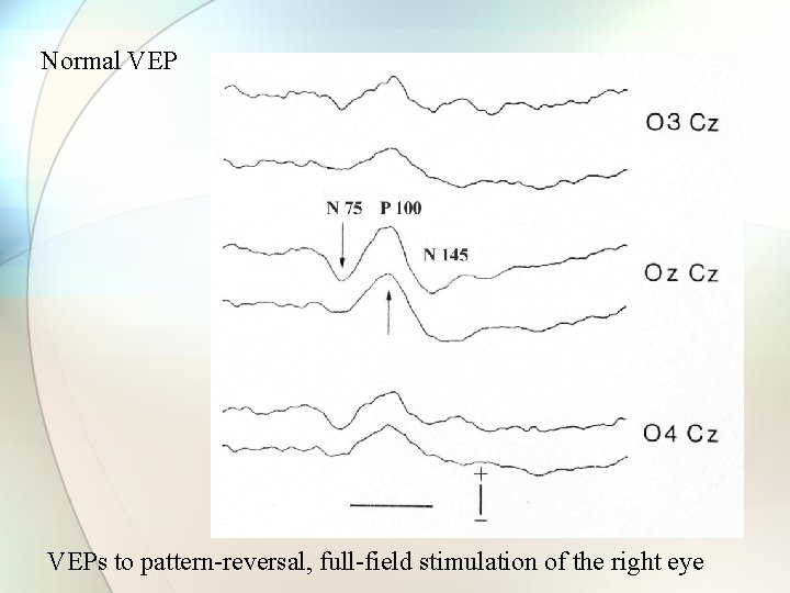 Normal VEPs to pattern-reversal, full-field stimulation of the right eye 