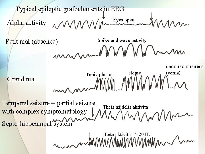 Typical epileptic grafoelements in EEG Eyes open Alpha activity Spike and wave activity Petit