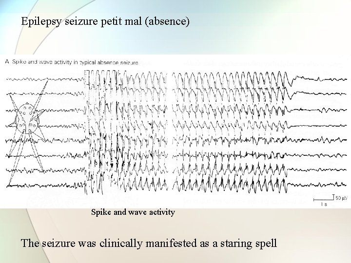 Epilepsy seizure petit mal (absence) Spike and wave activity The seizure was clinically manifested