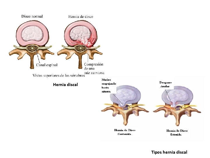 Hernia discal Tipos hernia discal Hernia discal Tipos hernia discal