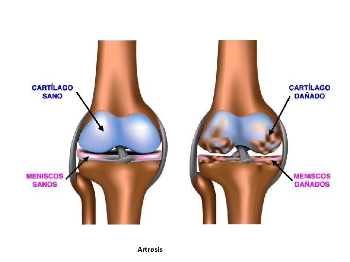 Artrosis Artrosis