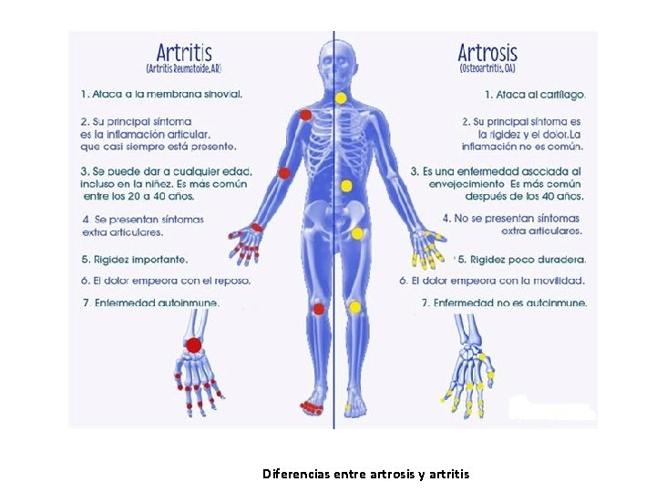Diferencias entre artrosis y artritis Diferencias entre artrosis y artritis