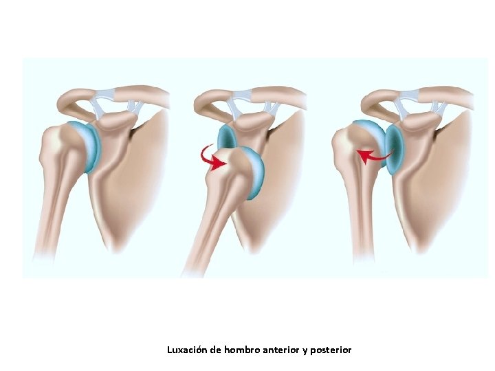 Luxación de hombro anterior y posterior Luxación de hombro anterior y posterior