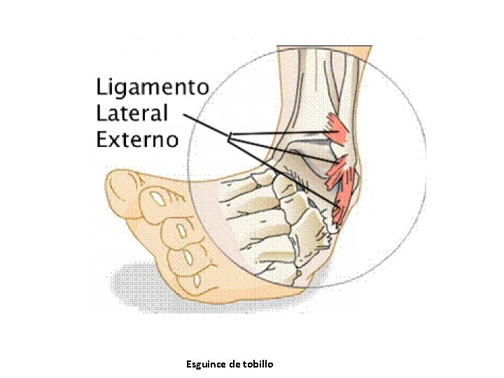 Esguince de tobillo Esguince de tobillo