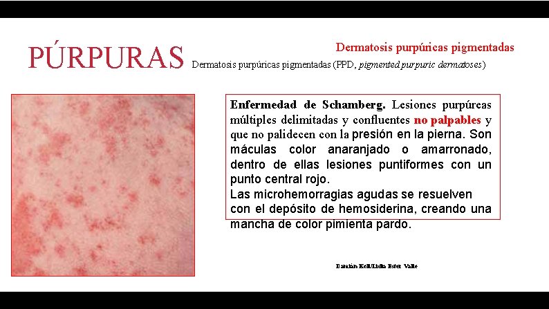 PÚRPURAS Dermatosis purpúricas pigmentadas (PPD, pigmented purpuric dermatoses) Enfermedad de Schamberg. Lesiones purpúreas múltiples