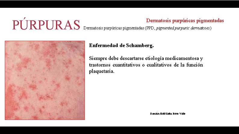 PÚRPURAS Dermatosis purpúricas pigmentadas (PPD, pigmented purpuric dermatoses) Enfermedad de Schamberg. Siempre debe descartarse