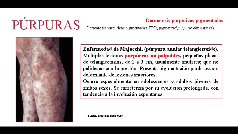 PÚRPURAS Dermatosis purpúricas pigmentadas (PPD, pigmented purpuric dermatoses) Enfermedad de Majocchi. (púrpura anular telangiectoide).