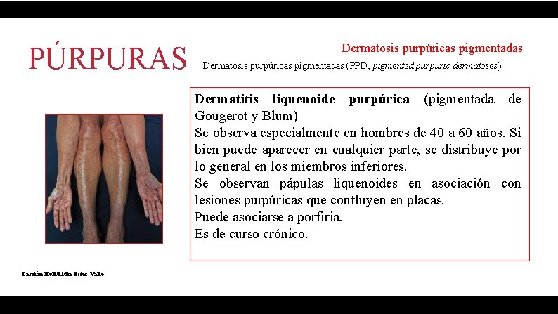 PÚRPURAS Dermatosis purpúricas pigmentadas (PPD, pigmented purpuric dermatoses) Dermatitis liquenoide purpúrica (pigmentada de Gougerot