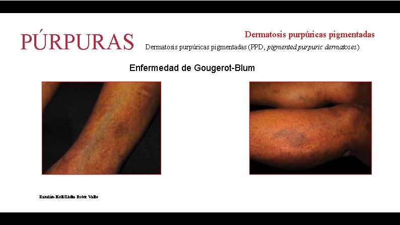 PÚRPURAS Dermatosis purpúricas pigmentadas (PPD, pigmented purpuric dermatoses) Enfermedad de Gougerot-Blum Damián Koll/Lidia Ester