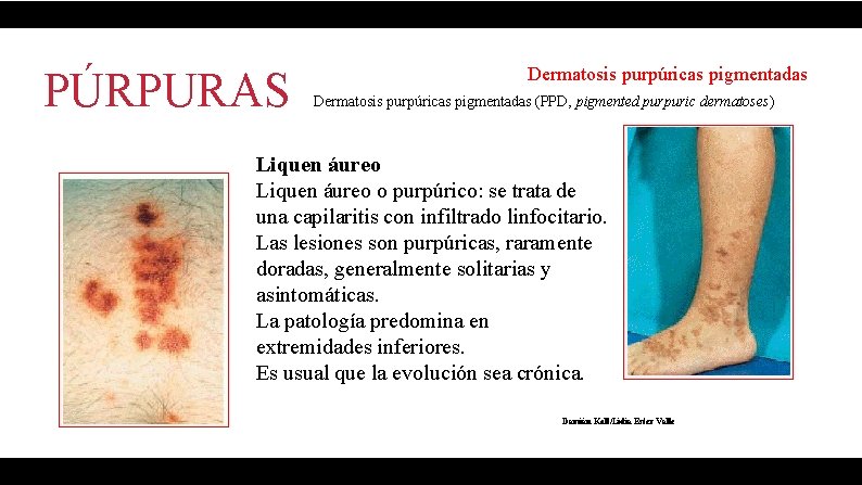 PÚRPURAS Dermatosis purpúricas pigmentadas (PPD, pigmented purpuric dermatoses) Liquen áureo o purpúrico: se trata