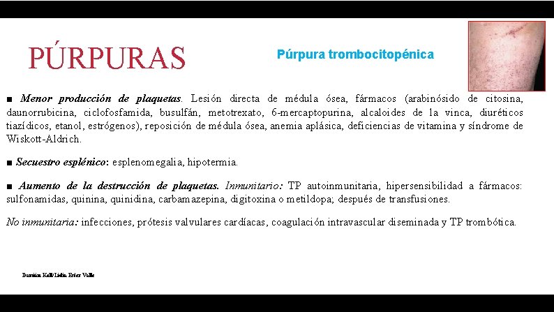 PÚRPURAS Púrpura trombocitopénica ■ Menor producción de plaquetas. Lesión directa de médula ósea, fármacos